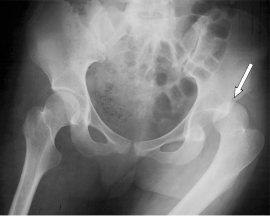 Posterior Hip Dislocation The Trauma Pro