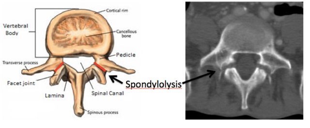 Pars Fracture Lumbar Spine