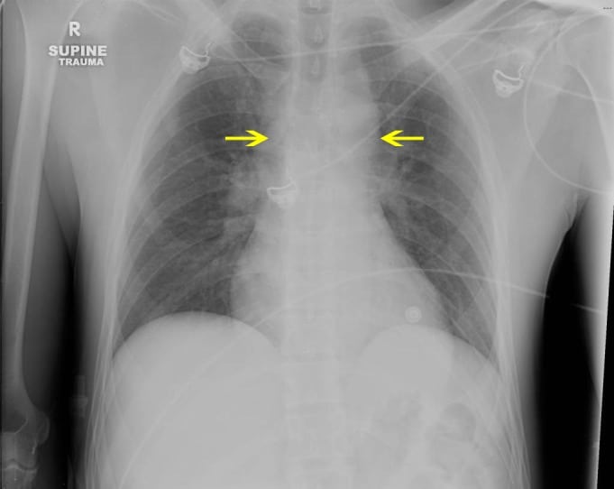 mediastinum-introduction-and-normal-anatomy-radiology-key