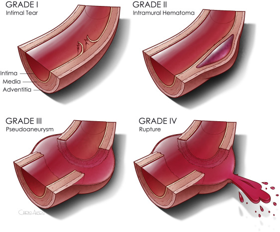 best-of-aast-2022-9-management-of-low-grade-blunt-thoracic-aortic